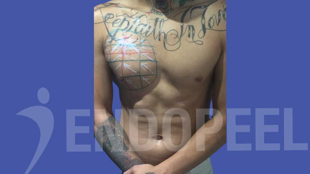 right male endopeel pectoroplasty