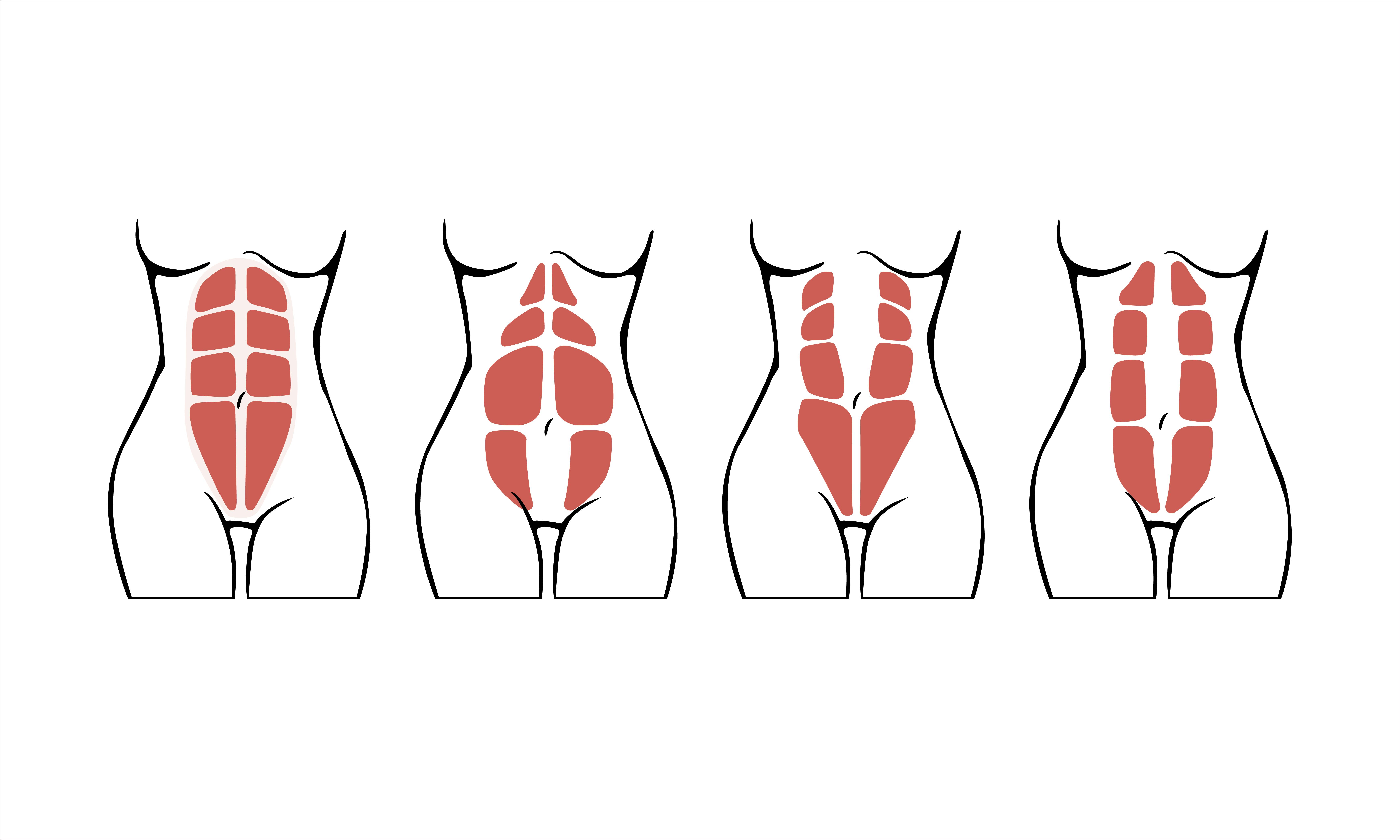 abdomen-diastasis