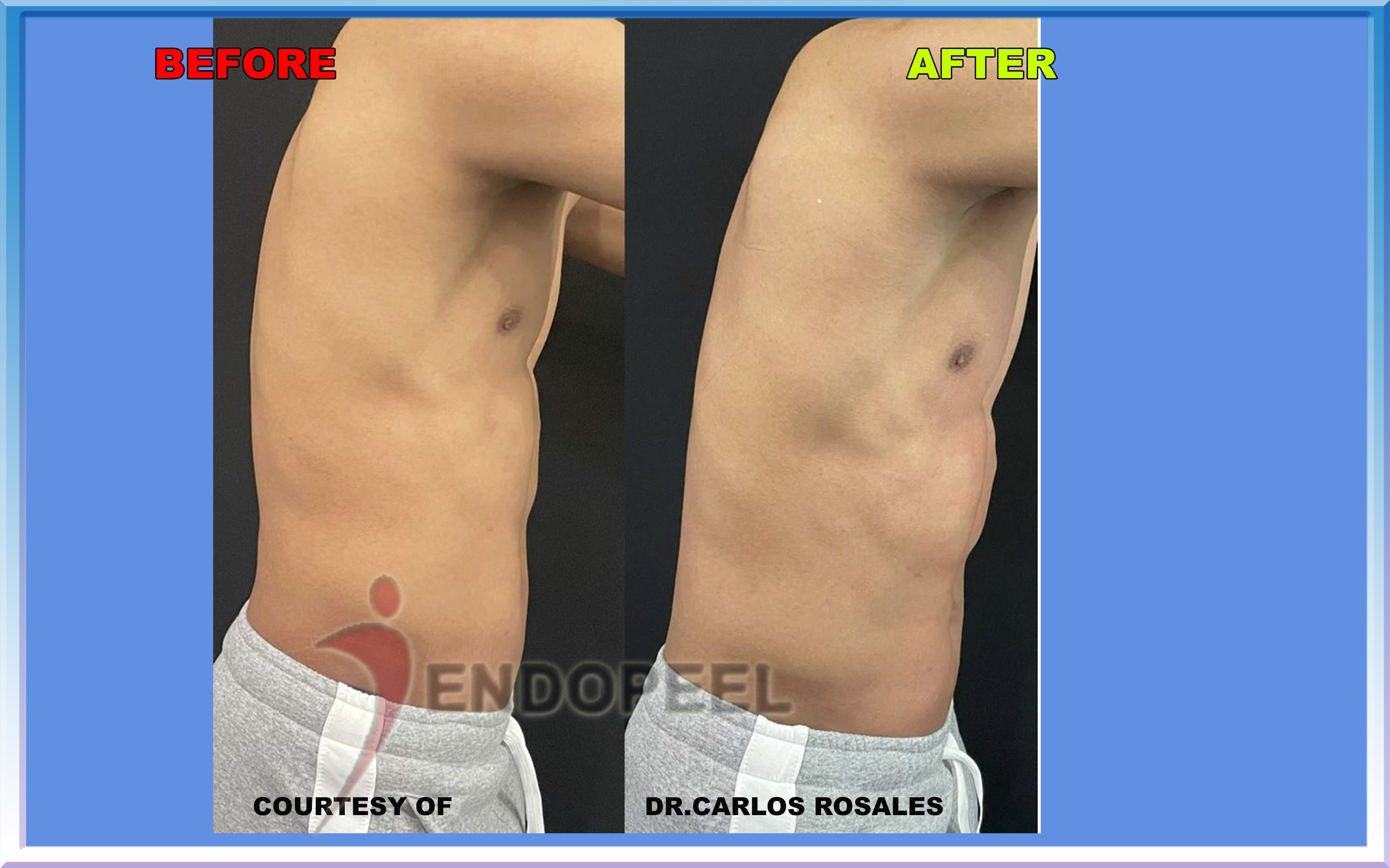 millenium-6packs-r-profile-view-carlos