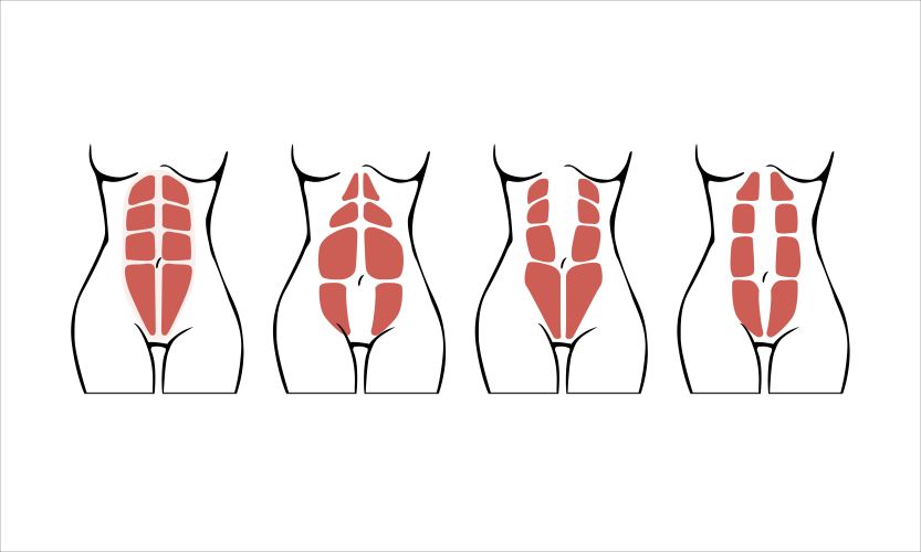 abdomen-diastasis